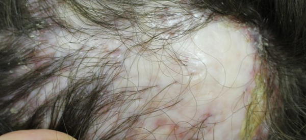 Симптомы и лечение декальвирующего фолликулита