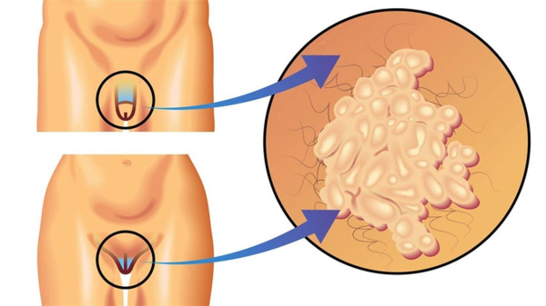 Как вирус папилломы влияет на беременность?