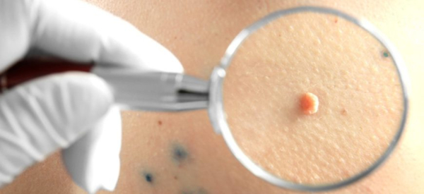 Влияет ли беременность на возможность удалять бородавки?