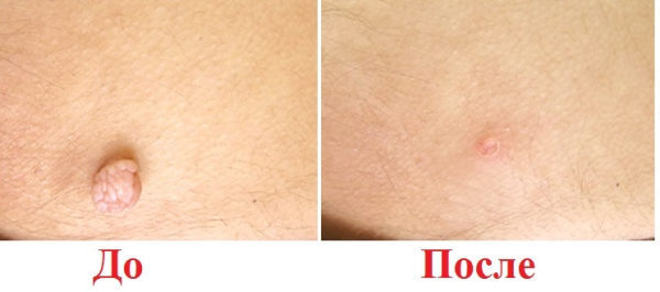 Уход после электрокоагуляции папиллом: основные рекомендации