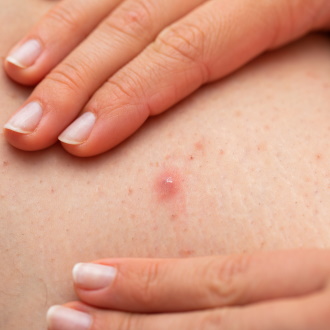 Хронический фолликулит: причины, симптомы и методы лечения