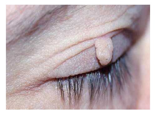 Папилломы на веках: лечение в домашних условиях народными средствами