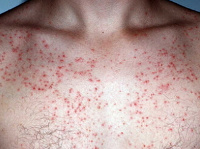 Бактериальный фолликулит: причины, симптомы и лечение