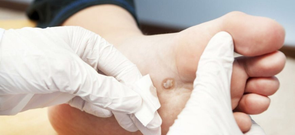 Почему бородавка чернеет: основные причины