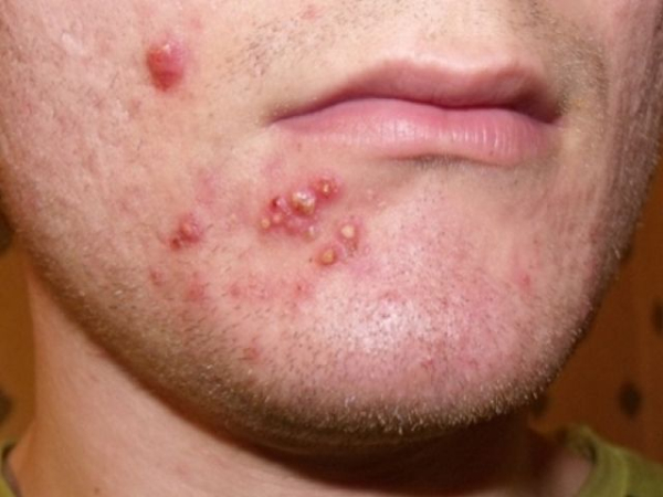 Симптомы и лечение декальвирующего фолликулита