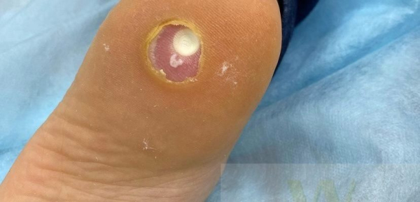 Как избавиться от куриной бородавки на ноге