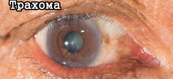 Трахома глаз: причины, симптомы, лечение и профилактика