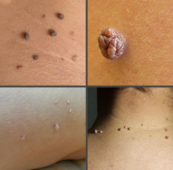 Висячие бородавки на теле: причины и лечение