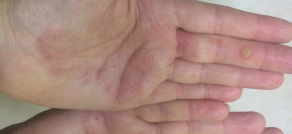 Чешется и не проходит бородавка на спине: советы и рекомендации