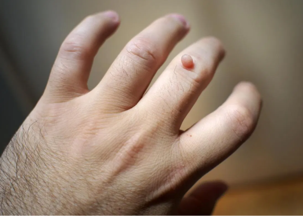 Как избавиться от сухих бородавок