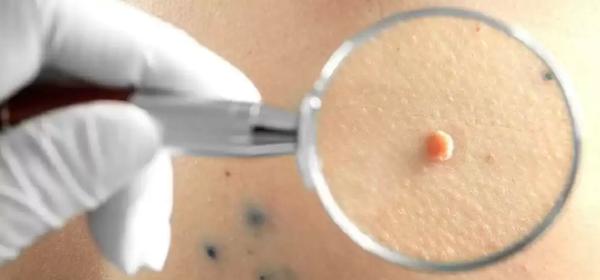 К какому врачу обращаться при папилломах во рту?