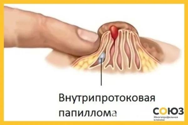 Лечение папилломы молочной железы народными средствами