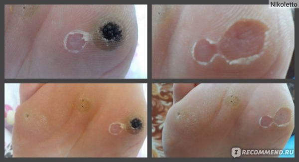 Прижигание папиллом жидким азотом: последствия и отзывы