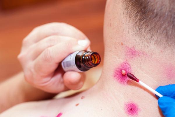 Как удалить папилломы касторовым маслом: применение и отзывы