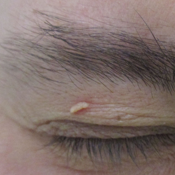 Какие виды бородавок на лице существуют?