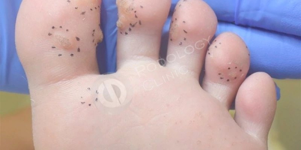 Как лечить бородавку на пятке у ребенка