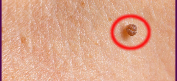 Как отличить родинку от папилломы?