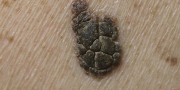 Вульгарные бородавки на лице: фото и лечение