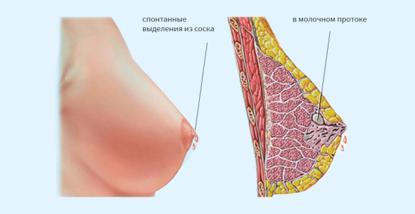 Как удалить папиллому на соске?