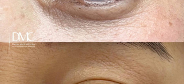 Бородавки на веке глаза: причины, симптомы и лечение