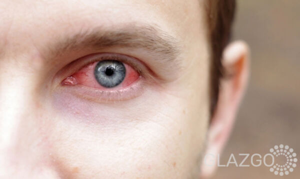 Кератоконъюнктивит: причины, симптомы, лечение, профилактика