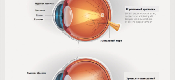 Катаракта у детей: причины, симптомы, лечение, осложнения