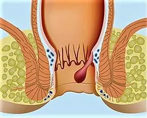 Что такое анальная бородавка и как ее лечить