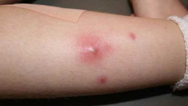 Гнойный фурункул: особенности недуга и лечение