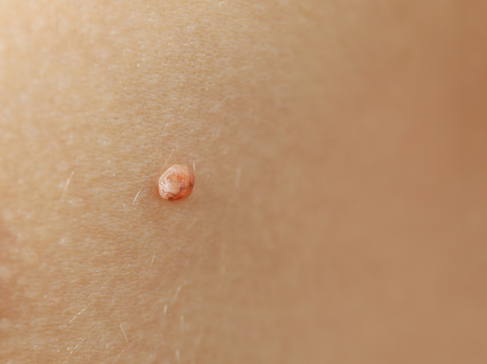 Лечение бородавок народными средствами в домашних условиях