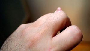 Бородавки между пальцев руки: причины, симптомы, лечение