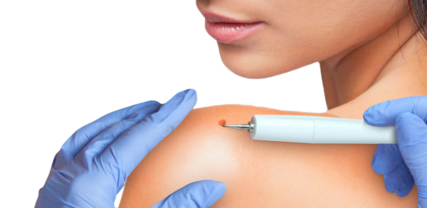 Какая методика лучше: лазерное удаление или электрокоагуляция папиллом?