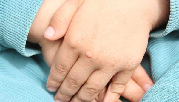 Передаются ли бородавки через рукопожатие