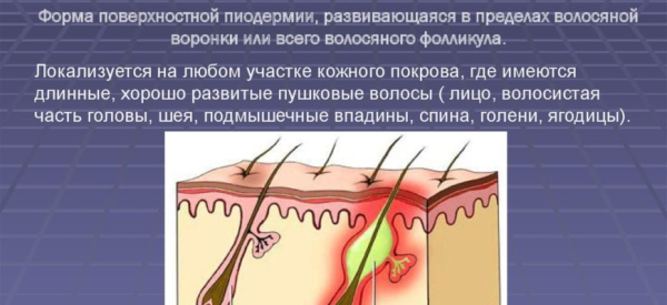 Хронический фолликулит: причины, симптомы и методы лечения