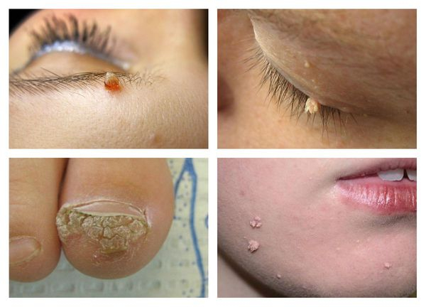 Бородавка на попе у ребенка: причины, симптомы и лечение