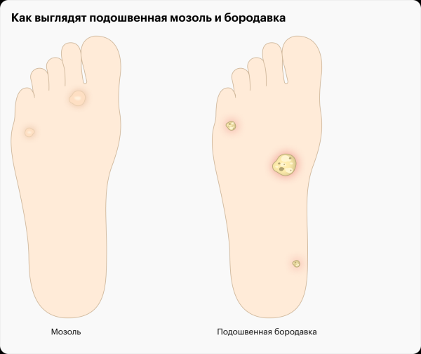 Как отличить мозоль от бородавки у детей