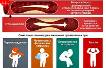 Стенокардия: причины, симптомы, первая помощь и лечение