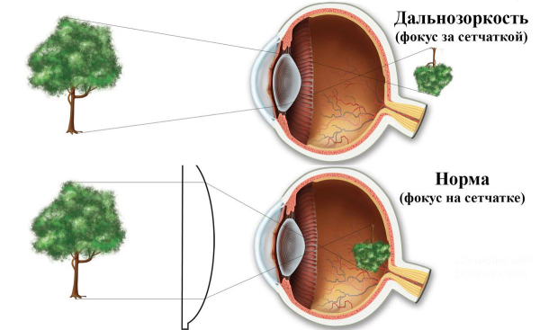 Гиперметропия у взрослых: причины и лечение дальнозоркости