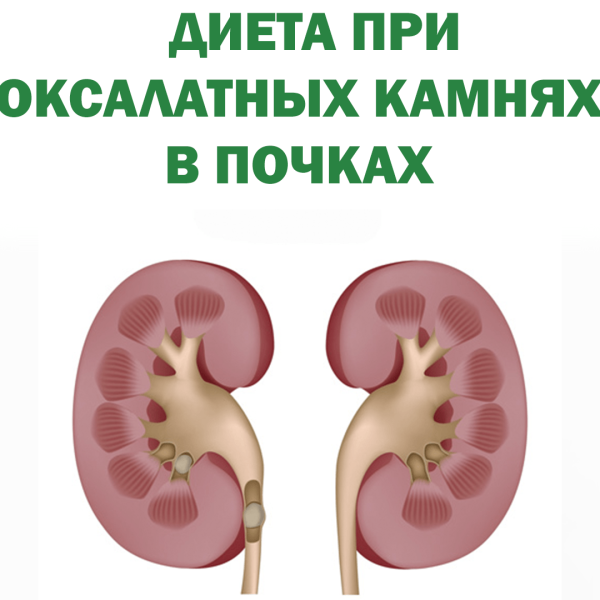 Оксалатурия: причины, симптомы, лечение, диета
