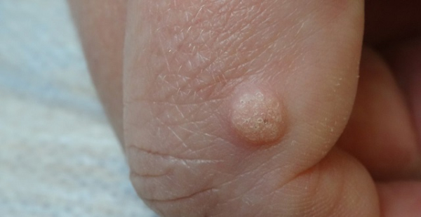 Как выглядит бородавка в начальной стадии?