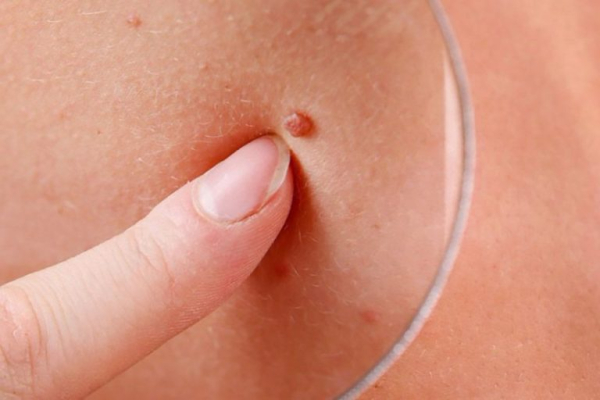 Бородавка на подбородке у ребенка