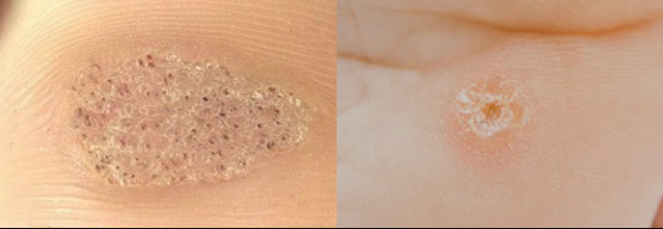 Как отличить стержневую мозоль от подошвенной бородавки