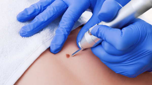 Уход за раной после удаления папилломы радиоволновым методом