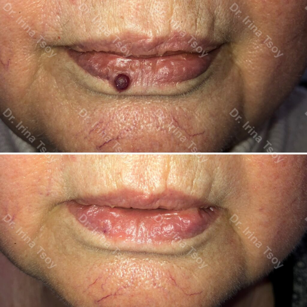 Красные папилломы на теле: причины появления