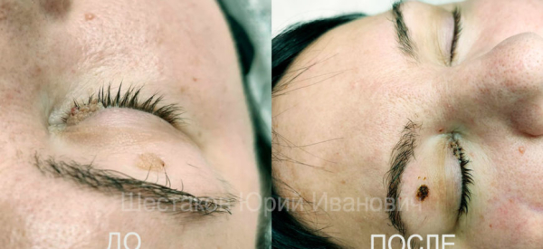 Как удалить бородавки на нижнем веке глаза: эффективные методы и советы