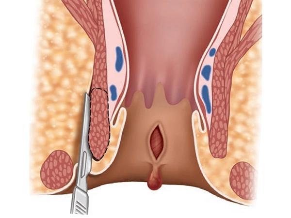 Как лечить папиллому ануса у ребенка?