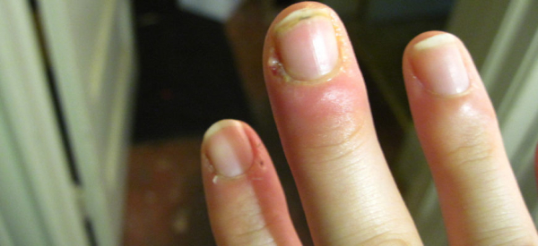 Панариций на пальце руки: причины, симптомы, лечение