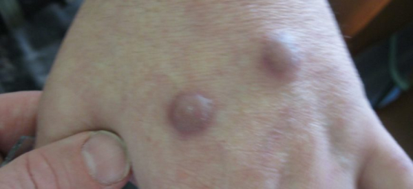 Споротрихоз у человека: пути инфицирования, симптомы, лечение