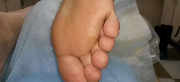 Особенности лечения подошвенных папиллом