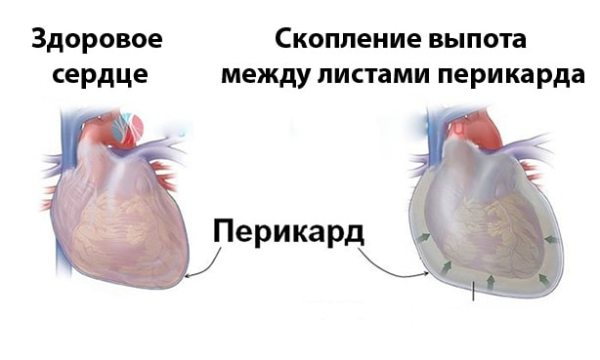Перикардит сердца: причины, симптомы, лечение