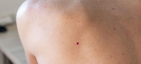 Красные папилломы на теле: причины появления